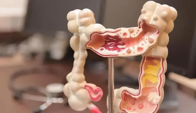 结直肠癌发病率连年攀升，它们或是“元凶”！早筛查、用三招，防癌变