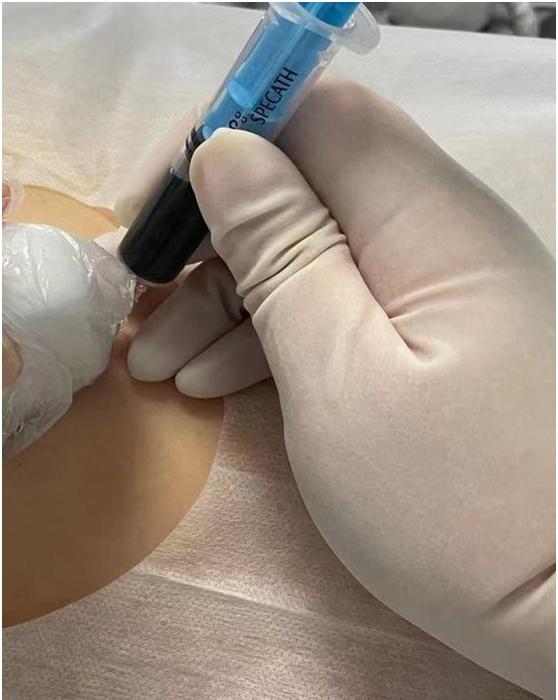 超声|胆囊炎急性发作却不能手术怎么办？这个方法为他赢得手术机会