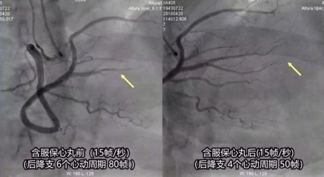 心之所向、从善如流——麝香保心丸改善冠脉慢血流