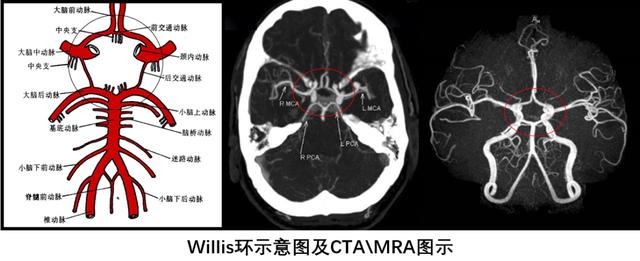 脑内的Willis环，你知道吗？