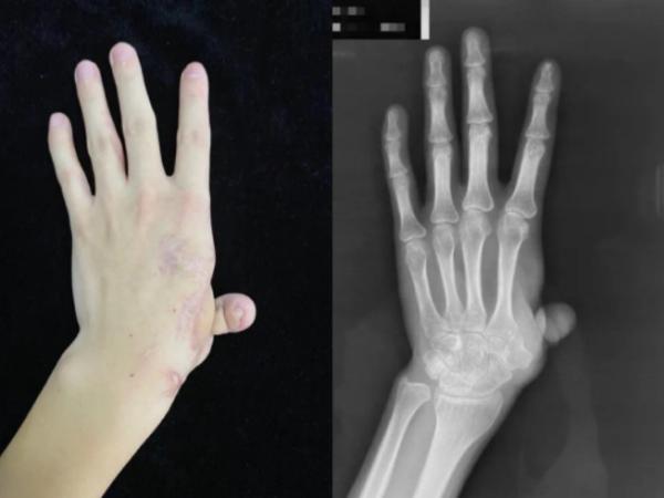 北京积水潭医院用3D打印技术为患者重建拇指