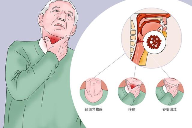 老觉得咽部有异物感？专家：警惕下咽癌