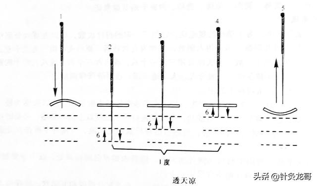 针灸常用补泻手法介绍，建议初学者收藏