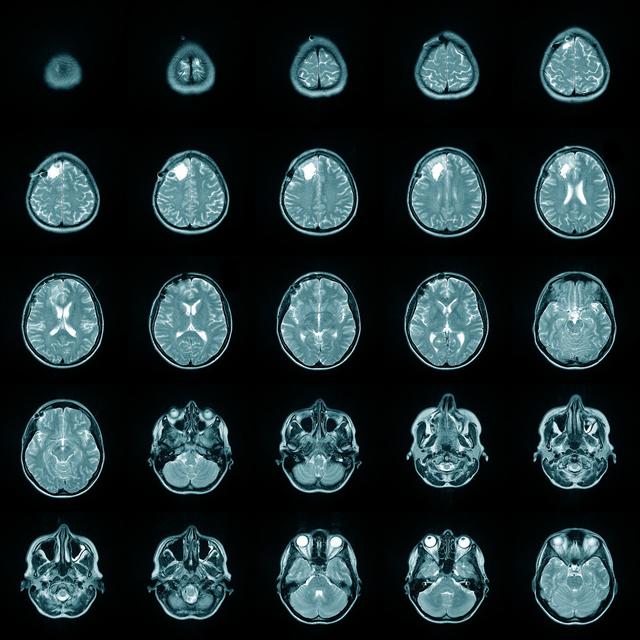 脑科医生带您解读：CT/磁共振报告上的“脑萎缩”是不是病