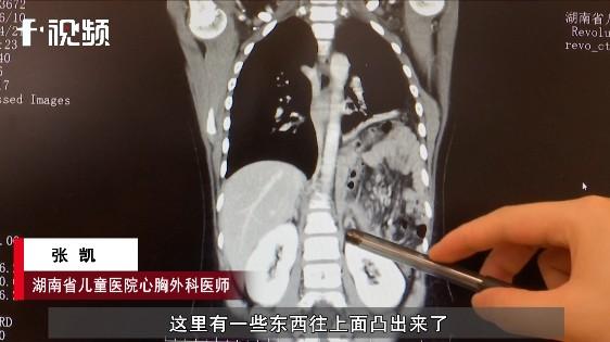 小燕|湖南10岁女孩剧烈咳嗽后持续腹痛，检查发现胃肠道竟移位到了胸腔内