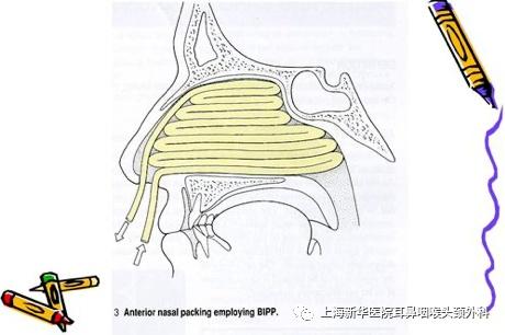 出血|冬春换季易流鼻血，点点血滴的处理，你做对了吗？