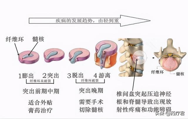 女子学“动物爬”3个月，治好了腰病？还吸引30多人加入团队