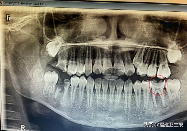 壮壮|宁德13岁男孩不愿意吃饭，一查牙齿惊呆！医生：这种想法，错误