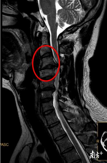 26岁的身体60岁的颈椎！广东小伙差点瘫痪