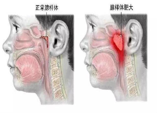 「超级宝妈」砭治腺样体肥大、小儿磨牙