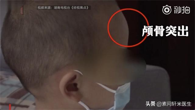 『你的育儿经』过敏宝宝的家长请注意！又见“大头娃娃”，害人的假奶粉还在卖