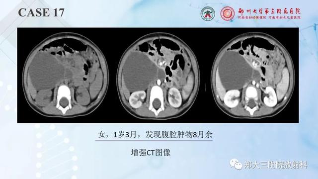 儿童腹部囊性病变诊断思路分析