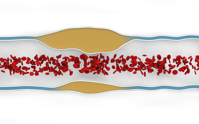 晨起后身体出现4种不适，或是血管&quot;堵塞&quot;警惕血栓&quot;上身&quot;