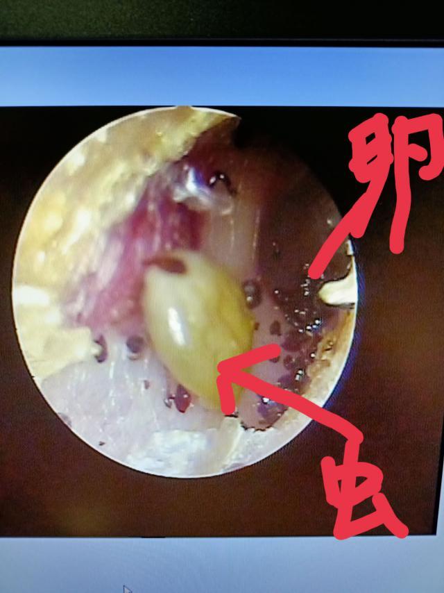 大连8岁男孩耳朵疼里面竟有蜱虫且已产卵