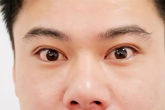 甲状腺结节发展到几级是癌症？医生：为了防止结节癌变，2物少吃