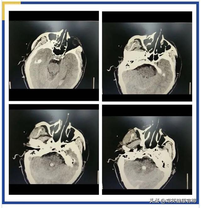 万一脑出血了，正规诊疗流程你知道吗？