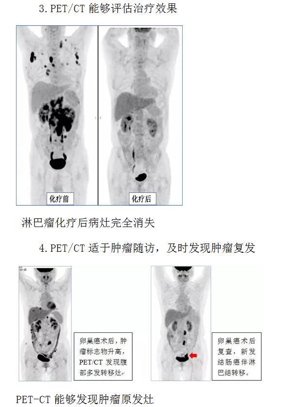 检查|都是拍片子，什么时候需要用到PET-CT呢？