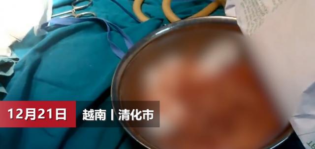 寄生虫|细思极恐！越南男子腹部取出上百条寄生虫