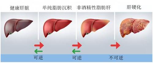 【健康提醒】轻度脂肪肝也会增加71%的死亡风险……小病千万莫忽视！