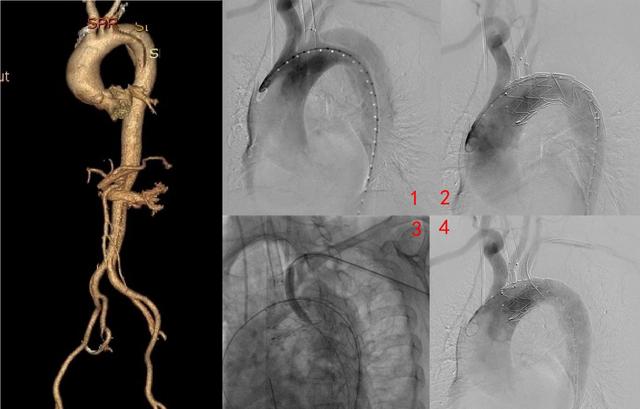 主动脉|山大二院分支型支架置入并原位开窗救治急性复杂主动脉夹层患者