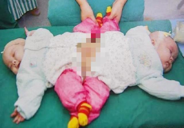 超级宝妈|11年前，国内首例“坐骨连体”双胞胎降生，现状如何？莫大的幸运