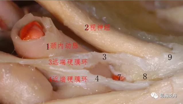 超实用的颈内动脉CTA分段