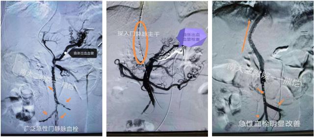 南昌大学第二附属医院消化内科2020年TIPS首破百例再创新高