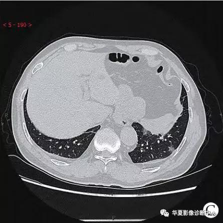 「影像进展」新冠肺炎的CT典型和不典型表现以及影像学分期