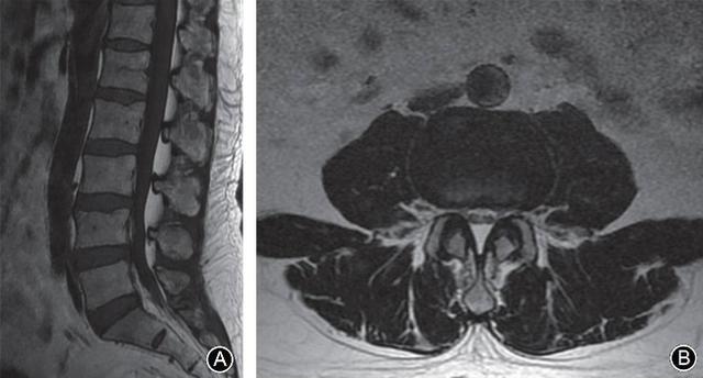 四个诊断腰椎管狭窄的MRI征象，千万不能忽视
