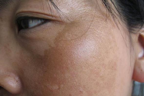 黄褐斑|黄褐斑影响面容，4种食物易“伤脸”，不