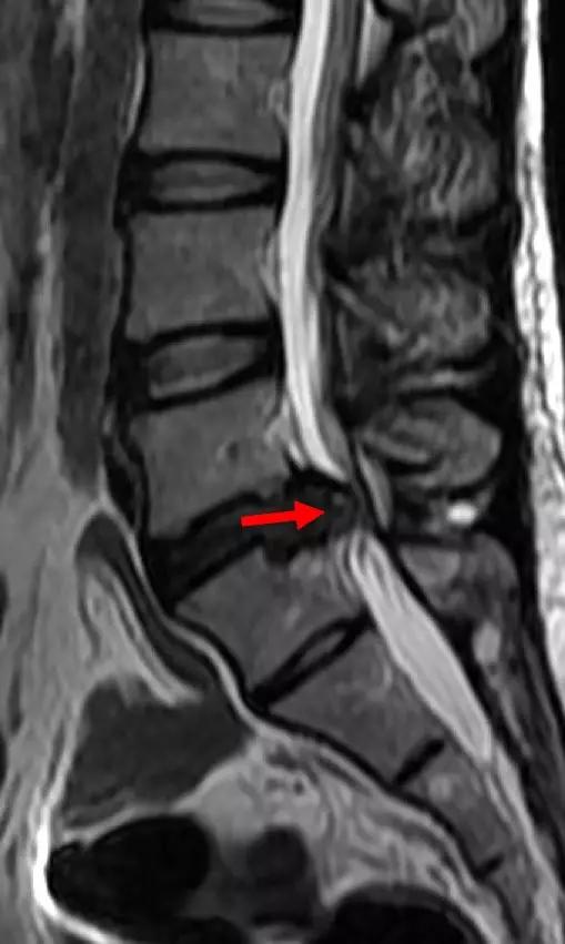 拿到片子不会看？6 种「椎间盘突出」的影像征象需注意