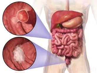 直肠癌|如何远离结直肠癌？