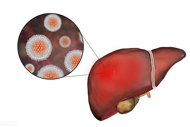 肝癌发生前并非毫无预兆，如若出现这几大症状，就需警惕