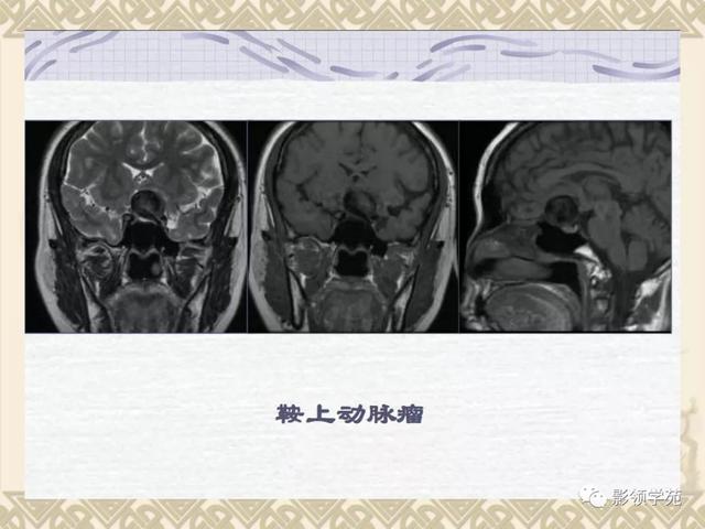 垂体病变的MRI诊断