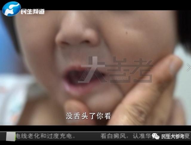 童童|这个感受不到疼痛的3岁小女孩，却让很多人心疼