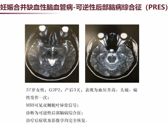 「超级宝妈」张馨：3类需要注意的妊娠合并神经系统疾病