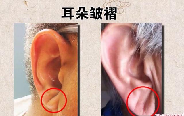 血脂异常的蛛丝马迹，在身上的这些地方就可以找到