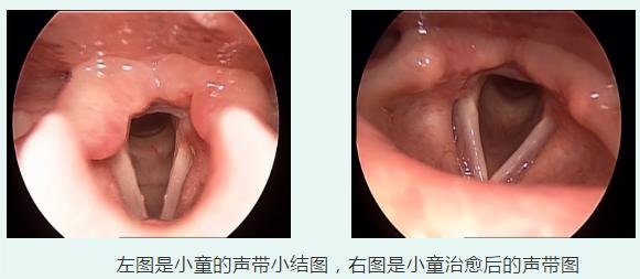 声带|音乐系才女却是一副“公鸭嗓”？医生提醒：嗓音的改变可能暗藏疾病的信号