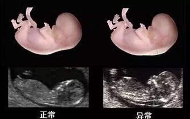 「你的育儿经」整个孕期做几次B超检查、分别多少周做？这有一份攻略，孕妈收藏