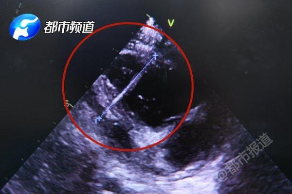 「光明网」扎心了！一岁宝宝心脏扎绣花针，凶手就在家里