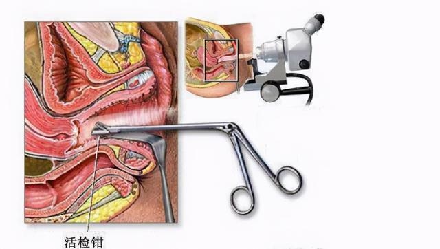 想确诊自己是否有宫颈癌，怎么筛查？