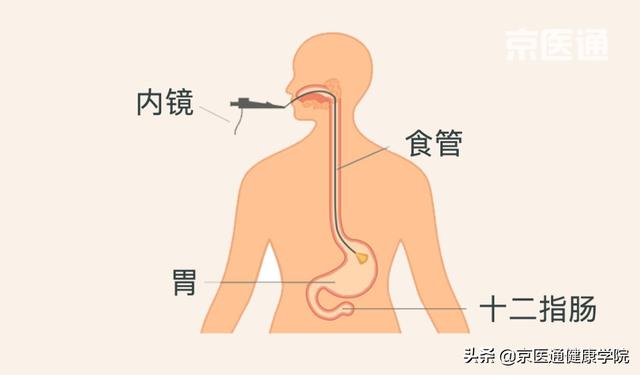 胃炎、肠化离胃癌有多远？教你快速读懂胃镜报告