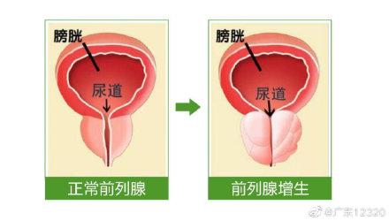 前列腺|什么是前列腺增生？