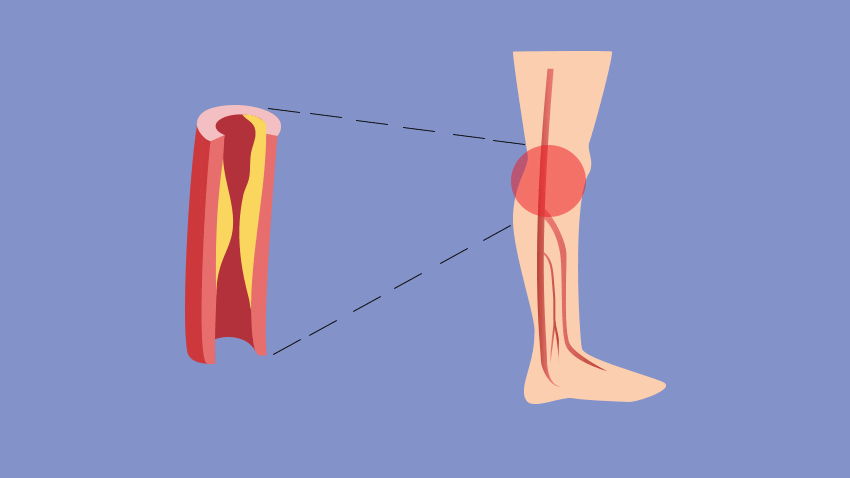 老年人下肢无力，有常见的五个原因，该如何预防和应对？请看此文