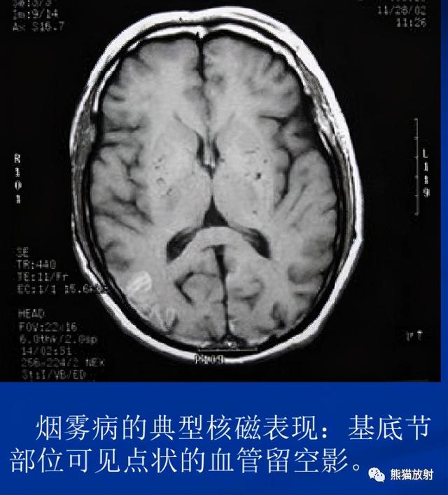 烟雾病的CT及MRI诊断