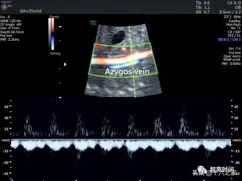 你的育儿经|胎儿下腔静脉缺如