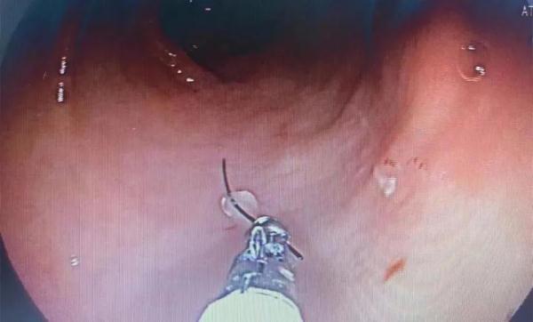 异物|青岛一女子腹痛多日，胃里竟发现5厘米长的钢丝