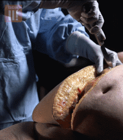 体重|一半国人超重！看完胖子的解剖内脏，只想减肥！