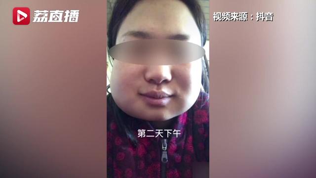 智齿|女子连拔3颗智齿肿成松鼠脸 专家称智齿若端正不用拔