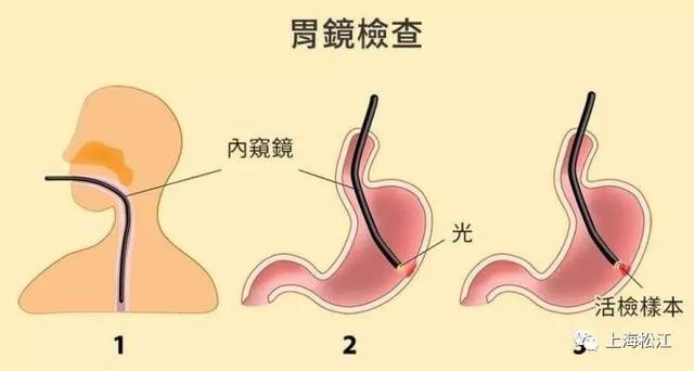 胃癌如何早发现、早诊断、早治疗？松江医生提醒注意这些